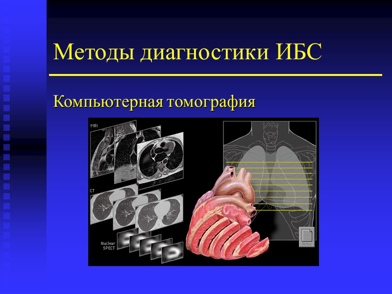 Методы диагностики ИБС Компьютерная томография